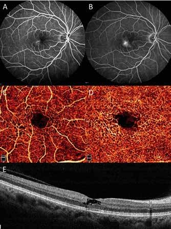 telangiectasia C OCT-A: increase in space between vessels in superficial capillary plexus. temporally to the fovea.