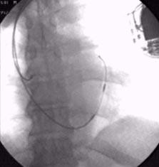A. Kutarski, Stała stymulacja lewego przedsionka Ryc. 8. Dwuprzedsionkowy układ stymulujący z elektrodą V-375 (Corox) w zatoce wieńcowej. Fig. 8. Biatrial pacing system with V-375 (Corox) lead implanted into coronary sinus.