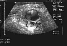 Po uprzednim zdezynfekowaniu pola operacyjnego, pod kontrolą ultrasonografii, umieszczono igłę 21 G w centrum tętniaka, podając do jego wnętrza 1,5 ml trombiny bydlęcej (Biomed Lublin), w