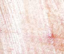 Perfekcyjny peeling chemiczny Skuteczność peelingu chemicznego zależy od mechanizmu działania wykorzystanego w nim składnika aktywnego, formuły preparatu, sposobu jego aplikacji, a także od stanu