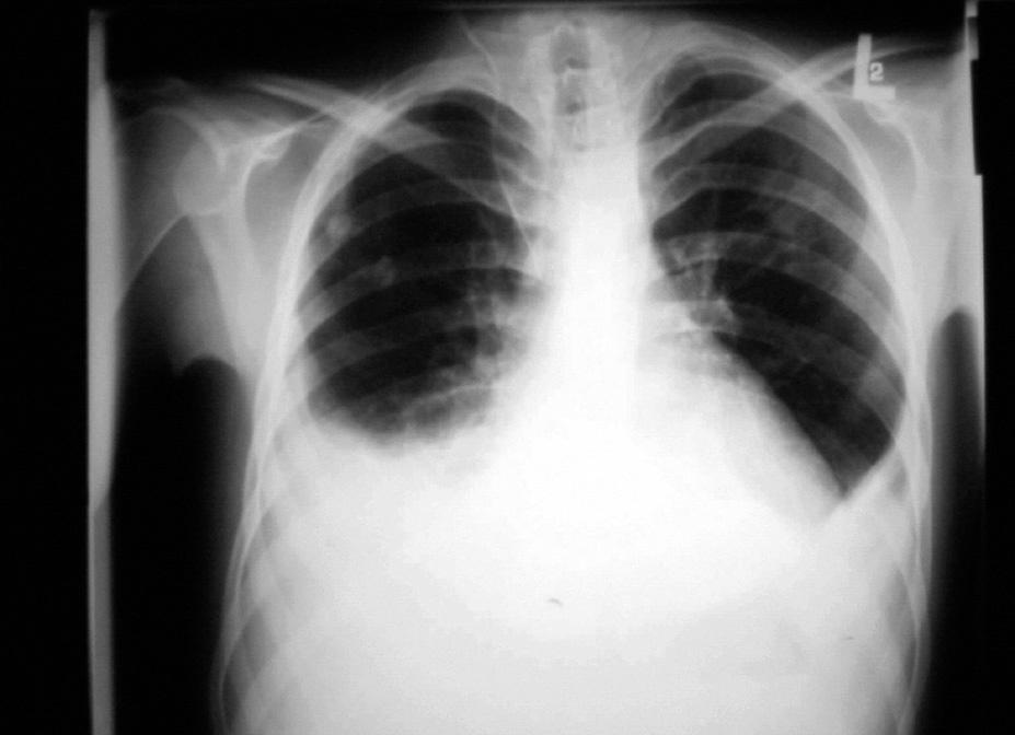Folia Cardiol. 2004, tom 11, nr 9 Rycina 1. Zdjęcie radiologiczne klatki piersiowej. Powiększona sylwetka serca. Zastój w krążeniu płucnym. Płyn w jamach opłucnowych Figure 1. Chest radiogram.