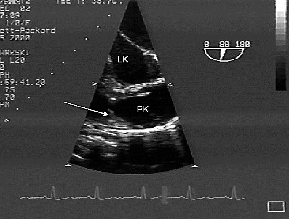 Right bundle branch block, unspecific ST-T changes Rycina 3. Echochardiogram rejestracja przezprzełykowa. Dwujamowa prawa komora.