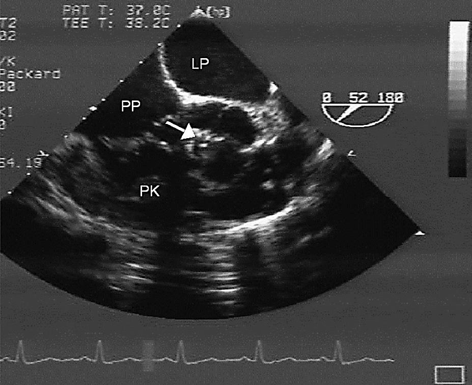 Double chambered right ventricle.