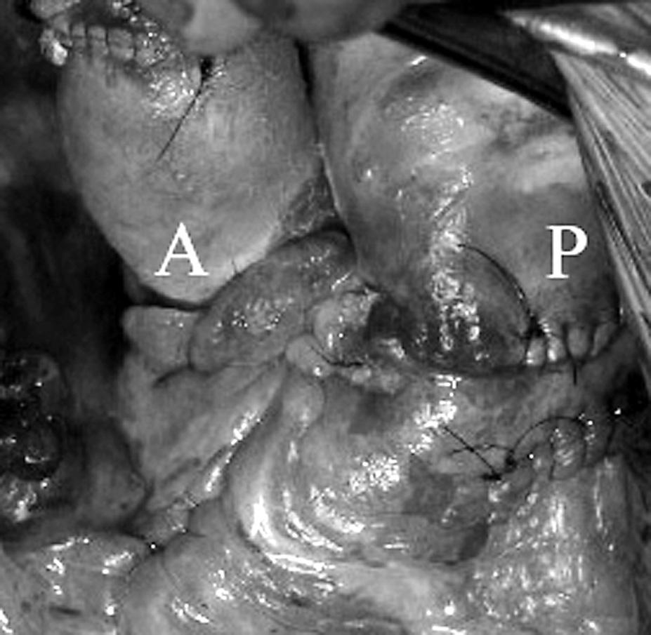 Folia Cardiol. 2004, tom 11, nr 9 Rycina 5. Zdjęcie śródopracyjne. Homograft aortalny (A), wszczepiony w pozycji aortalnej, i homograft płucny (P) w drodze odpływu prawej komory Figure 5.