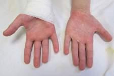 Rozdział 43 Zmiany skórne w przebiegu chorób zakaźnych u dzieci Manifestacje dermatologiczne Ryc. 6. Złuszczanie pozapalne na rękach w przebiegu płonicy (zdjęcie dzięki uprzejmości dr hab. n. med.