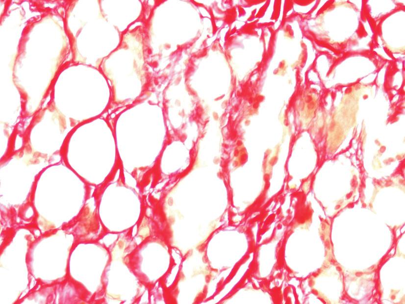Fotomikrografia barwienia PSR w świetle niespolaryzowanym próbki 50μm 50μm histologicznej potwierdzała odkładanie się kolagenu (Rys. 4a). Barwienie PSR w świetle Rys.