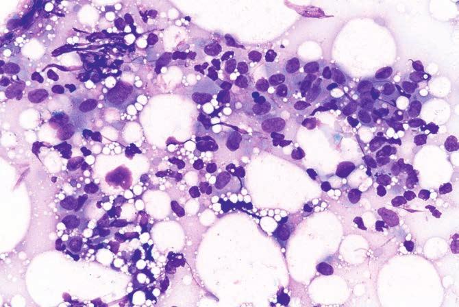 Materiał pobrano drogą biopsji aspiracyjnej cienkoigłowej, barwienie barwnikiem Giemsy, powiększenie 400 stwierdzono (ryc. 1).