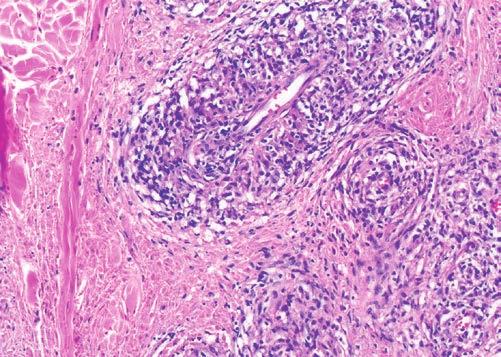 Ryc. 4. Obraz histologiczny skórnej odczynowej histiocytozy u psa widoczne okołonaczyniowe nacieki utworzone z histiocytów, z udziałem leukocytów. Barwienie hematoksylina-eozyna; powiększenie 100 Ryc.