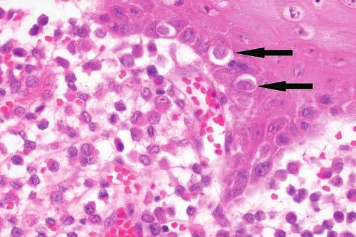 Ryc. 10. Histiocytoma u psa obraz histologiczny komórki rozrostu znajdują się tuż pod naskórkiem, a także w jego obrębie (strzałki). Barwienie hematoksylina- eozyna; powiększenie 200 Ryc. 11.