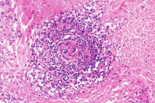 Barwienie hematoksylina-eozyna; powiększenie 100 leczenie immunosupresyjne, które doprowadza do całkowitej regresji zmian.