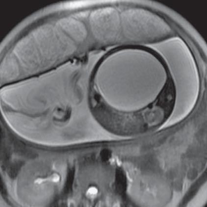 27. Oligohydramnios, agenesis of urinary bladder (MR of fetus, SST2 sequence, transverse plane)