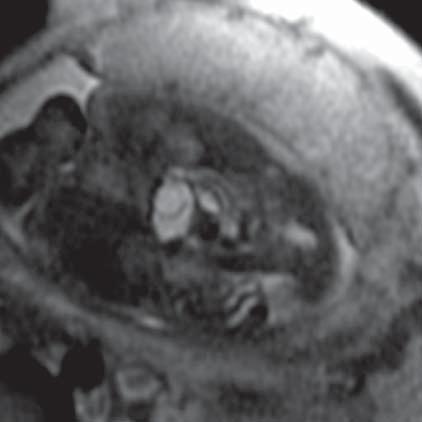 Ureterocele (MR of fetus, SST2 sequence, transverse plane) Ryc. 33.