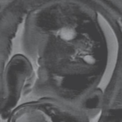 Uretral outflow (MR płodu, sekwencja SST2, płaszczyzna czołowa) Ryc. 34.