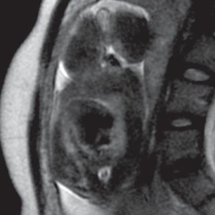 Cloaca (MR of fetus, SST2 sequence, sagittal plane) Ryc. 35.