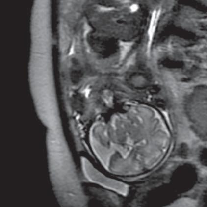 Rezonans magnetyczny płodu nowa metoda diagnostyczna w algorytmie prenatalnej