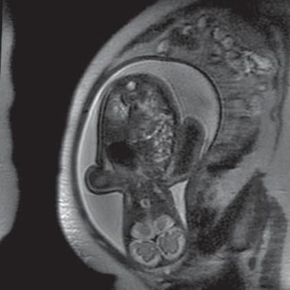 Dandy-Walker Syndrome (MR of fetus, SST2 sequence, transverse plane) Ryc. 11.