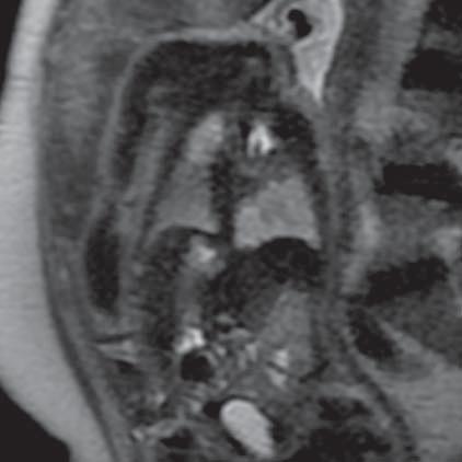 CCAM of lungs (MR of fetus, SST2 sequence, frontal plane) Ryc. 14.