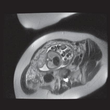 Measurement of volume of lung of fetus (MR of fetus, SST2 sequence, transverse plane) Ryc.