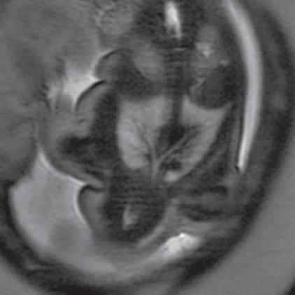 Normal trachea and oesophagus (MR of fetus, SST2 sequence, transverse plane) Ryc. 18.