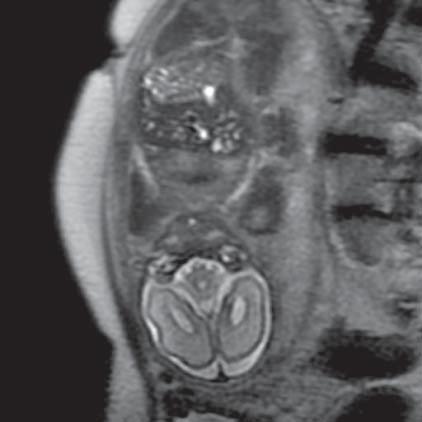 Evisceration (small intestine) (MR of fetus, SST2 sequence, sagittal plane) Ryc. 22.