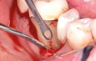 SonicLine Periodontologia 11 1 3 5