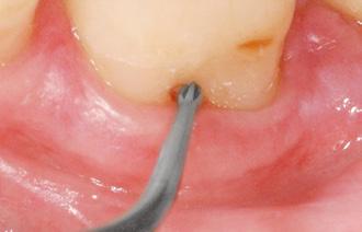 stosowania w leczeniu periodontologicznym