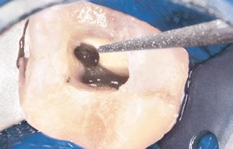 26 SonicLine Endodoncja 1 Endodoncja ƒ Tradycyjne leczenie endodontyczne Wskazania: Preparacja dostępu koronowego do komory miazgi i poszerzenie szyjkowego odcinka kanału korzeniowego w ramach