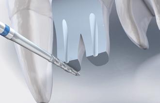 28 SonicLine Endodoncja 1 Endodoncja ƒ Leczenie endodontyczne metodą wsteczną Wskazania: Do poszerzania kanałów korzeniowych metodą wsteczną w ramach resekcji wierzchołka korzeniowego.