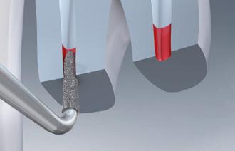 SonicLine Endodoncja 29 2 3 4 SF55 Zalecenia dot. stosowania w SF56.