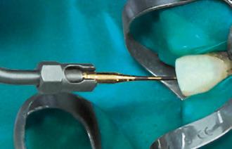 SonicLine Endodoncja 31 1 2 Zalecenia dot. stosowania: Kanał korzeniowy należy najpierw opracować w sposób tradycyjny z zastosowaniem powszechnie wykorzystywanego systemu (np.