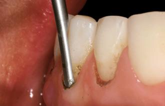 biologicznej w przypadku: Niesymetrycznej girlandy dziąsłowej [1] Uśmiechu dziąsłowego (gummy smile) [2] Naruszenia