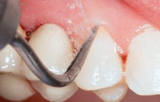 SF4L SF4R SF8 SonicLine Periodontologia 9 1 2 Perio Usuwanie złogów SF4,