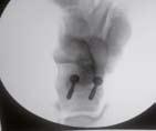 29-year-old patient, open reduction and cannulated screws used