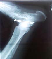 Open reduction and cannulated screws used to stabilize the bones. Legs put in plaster cast for 6 weeks, followed by rehabilitation.