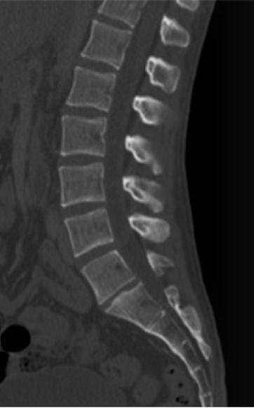 Zadanie 18. Którą metodą zostało wykonane badanie kręgosłupa zobrazowane na zdjęciu? Rezonansu magnetycznego. Tomografii komputerowej. Scyntygrafii statycznej. Radiologii klasycznej. Zadanie 19.
