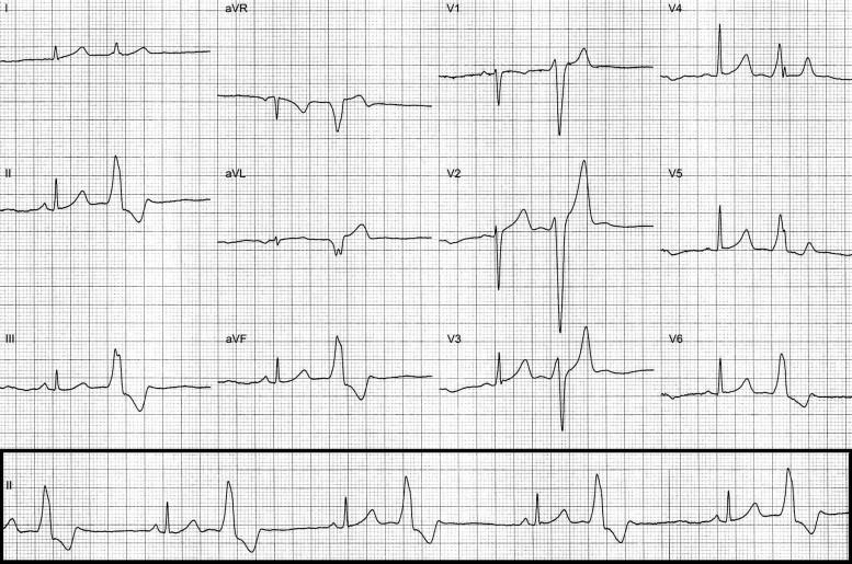 Który stan patologiczny został zarejestrowany podczas wykonywania badania EKG? Dodatkowe pobudzenia komorowe.