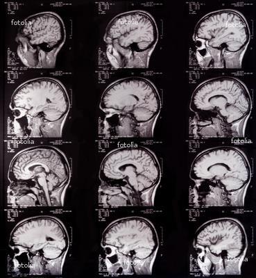 option=com_content&view= article&id=73:tomografia-komputerowa&catid=51:pracownie-diagnostyczne&itemid=67 Źródło promieniowania i detektory poruszają się po okręgu dookoła obrazowanej części ciała,