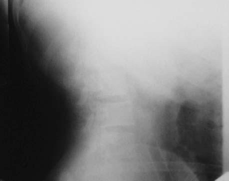 Krótszy okres hospitalizacji, szybszy czas powrotu do pełnej aktywności życiowej i zawodowej, mniejszy ból pooperacyjny, lepszy efekt kosmetyczny oraz rzadsze powikłania miejscowe były czynnikami