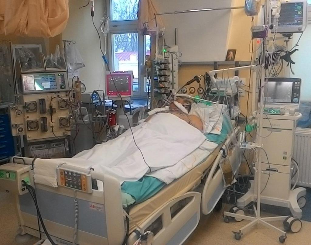Epidemiologia i powikłania tętniaków aorty piersiowej: Występowanie 5,9 10,4 na 100.000 / rok ok.