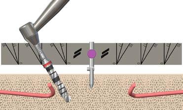 Pro Arch Guide jest używany w przypadkach bezzębia do chirurgicznego umieszczania implantów. Pro Arch Guide można łatwo wygiąć, aby dostosować go do łuku zębowego.