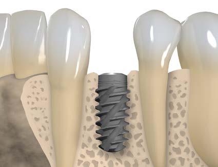 Ostateczne położenie implantu RB/WB Położenie koronowo - wierzchołkowe Implanty Straumann umożliwiają elastyczne pozycjonowanie implantu w zależności od indywidualnej anatomii, miejsca
