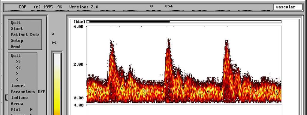 Podstawowe parametry sygnału dopplerowskiego prędkośi przepływu krwi Widmowa gęstość moy (widmo) s.d.p.p.k. Częstotliwość średnia Fśr wydatek (np.