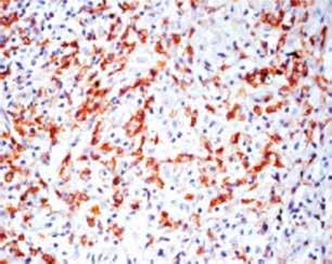 B) Clear positive immunohistochemical reaction to CD138 marking the plasma cells. 40x.