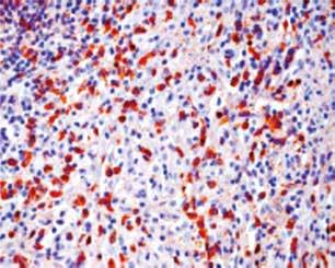 IgG4-related orbital disease is a general term for the pathologies in the orbital region. Different orbital locations are possible.