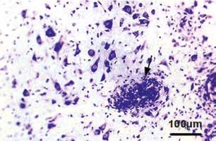 D) Inflammatory infiltrations, EAE animals, fed with hydrolysate in doses 5 and 20 mg/kg.
