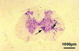 Inflammatory infiltrations marked by arrows. N motoneuron.