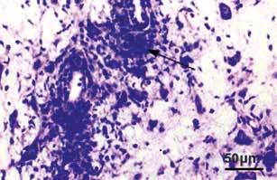 activity was observed. There were more perivascular infiltrates present (Fig.