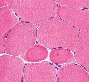 Adult, isolated respiratory chain complex IV deficiency with minimal manifestations A B Fig. 1. Hematoxylin and eosin staining of the muscle shows two Ringbinden (A).