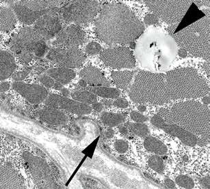 Electron microscopy shows lipid droplets (arrowhead) and subsarcolemmal accumulation of mitochondria (arrow) without paracrystalline inclusions (C). C Table I.