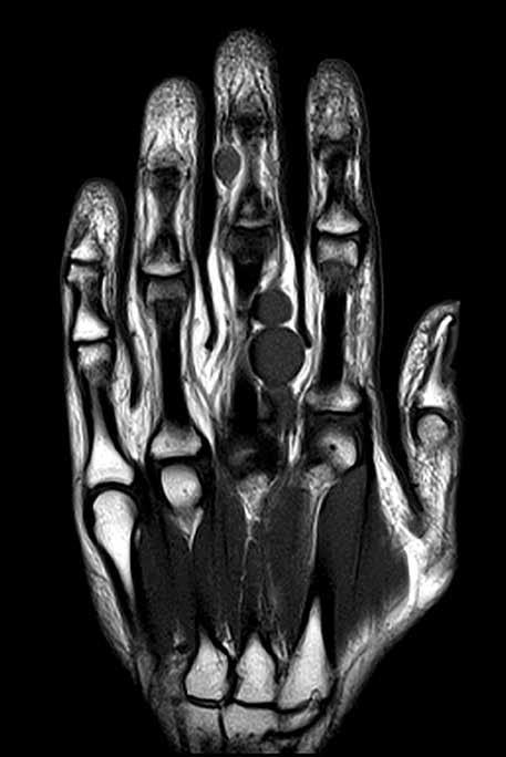 Segmental schwannomatosis along the proper digital nerve on the radial side of the third finger. The lesion originated at the level of the metacarpophalangeal joint and continued for about 33 mm.